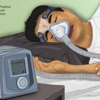 The Pros and Cons of Using a CPAP Machine for Sleep Apnea